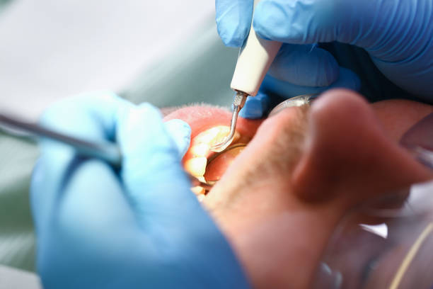 Best Emergency Dental Care for Broken or Chipped Teeth in Rich Hill, MO